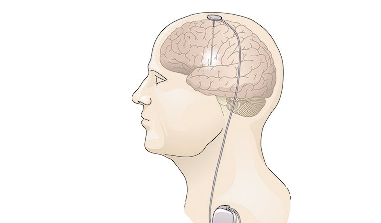 Derin Beyin Stimülasyonu Nedir? (DBS)